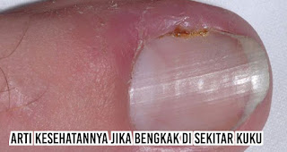 Arti kesehatannya jika Bengkak di sekitar kuku