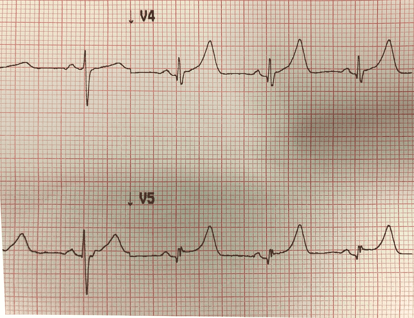 Отрицательный зубец р после qrs комплекса. Высокий коронарный зубец т на экг. Высокий коронарный зубец т на экг. Высокий зубец т на экг в v2 v3. Зубец т на экг.