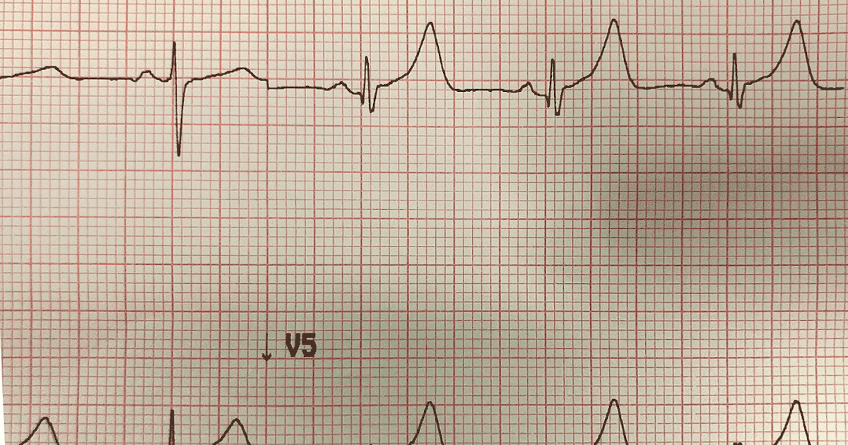 Двухфазный зубец т на экг. Высокие зубцы т на экг v1 v2 v3. Зубец т 2 3. Зубец т 2 3. Полярность зубца т.