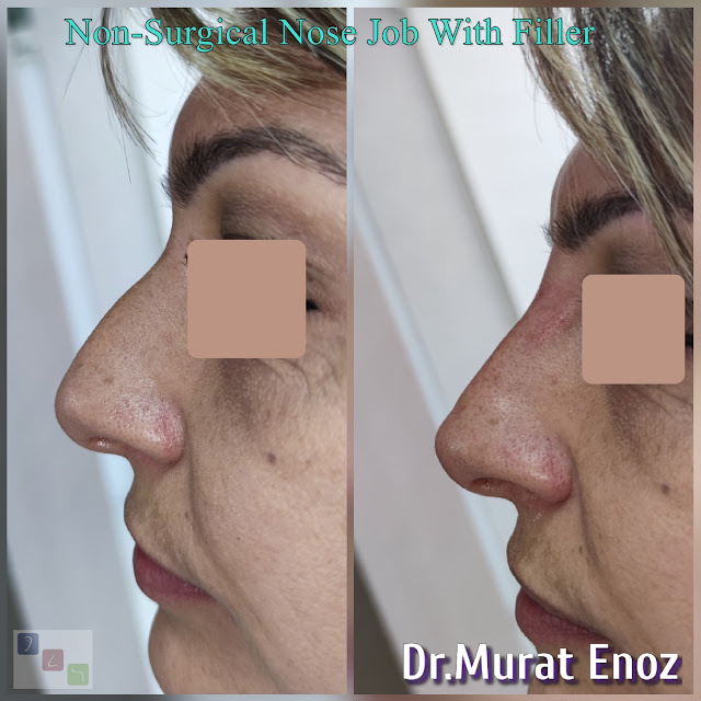 Cost of non-surgical rhinoplasty in Istanbul,Nose filler injection cost in Turkey,Cost of non-surgical nose job in Istanbul,Cost of non surgical nose job with filler in Istanbul,
