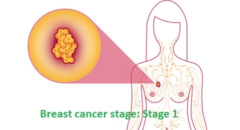 Breast cancer stage: Stage 1 Breast cancer stage: Stage 1
