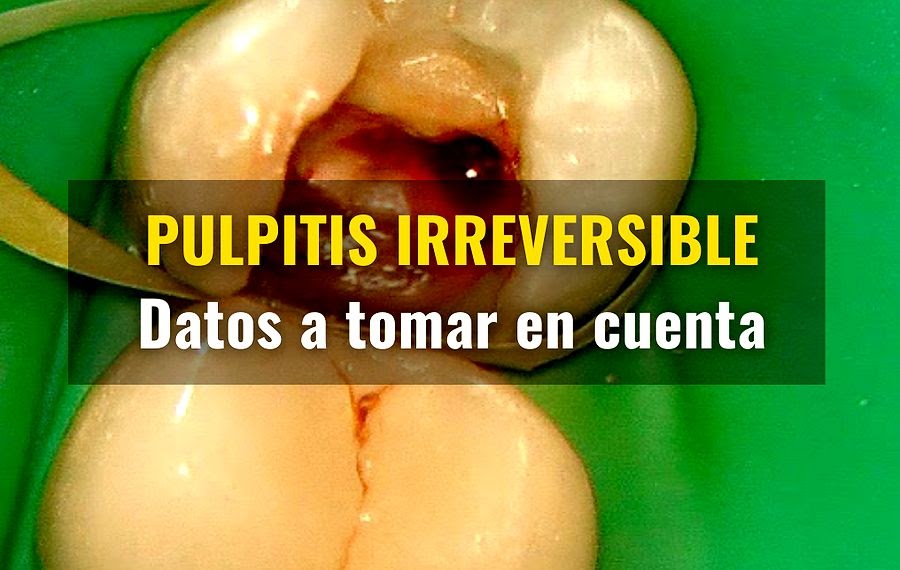 PULPITIS IRREVERSIBLE Datos a tomar en cuenta Ovi Dental PULPITIS IRREVERSIBLE Datos a tomar en cuenta Ovi Dental