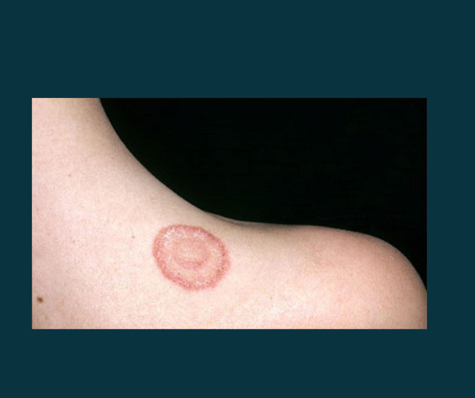 What is Symptoms, Types, and Treatment of Fungal Infection