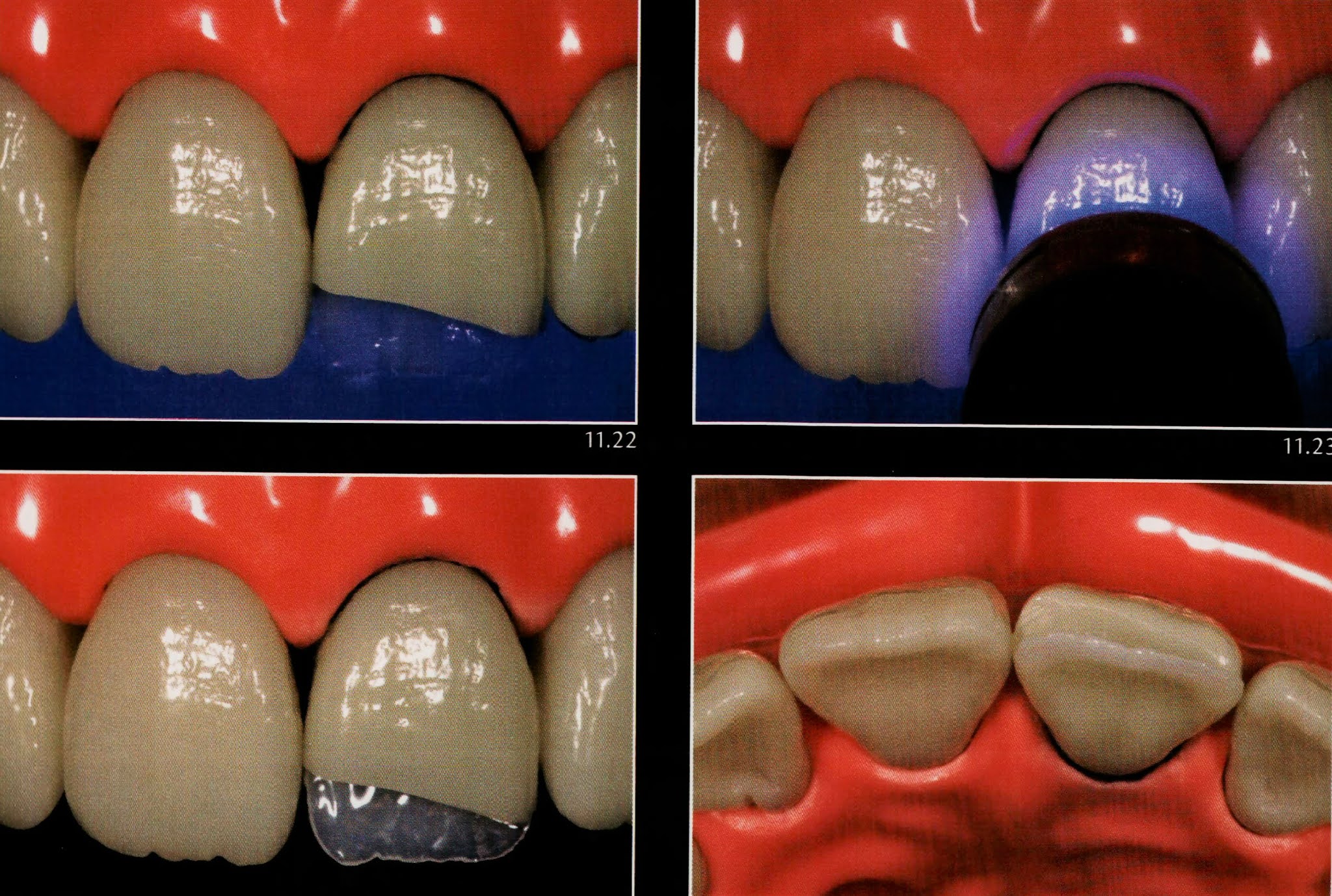 Class IV composite " silicone guide technique " Dental Esthetics
