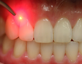 Laser+Dentistry