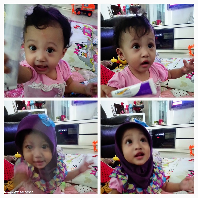 Photo collage of Aina when she was 1 year 1 month 5 days old. Picture Aina wearing a hijab and holding a Dermatix scar cream used to be applied to the scar on her forehead.