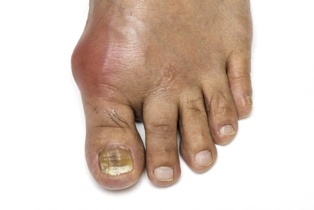 gout-on-foot