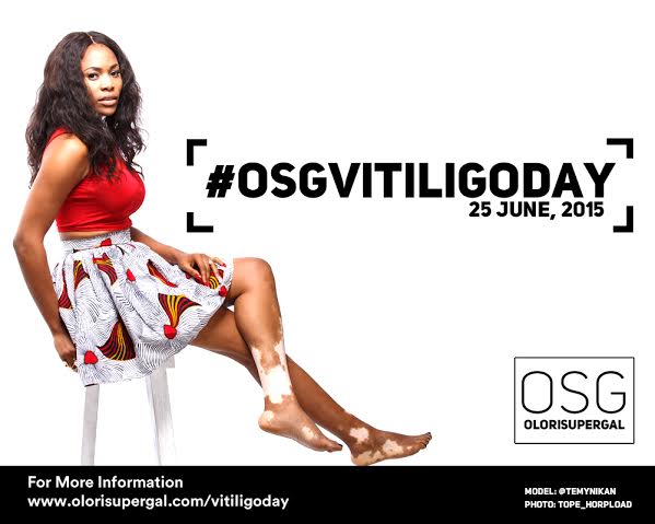 It's World Vitiligo day,an event for awareness of the Skin Condition. df
