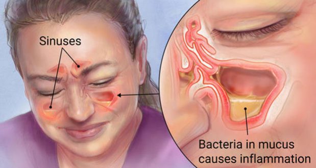 http://fikodominic.blogspot.com/2017/04/cara-mengobati-sinusitis-akut-secara.html