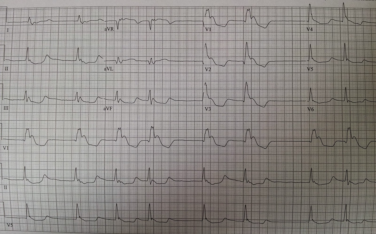 Dr. Smith's ECG Blog Hypothermia and Right Bundle Branch Block, with