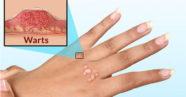 Hình ảnh tay bị mụn cóc (ảnh từ internet)