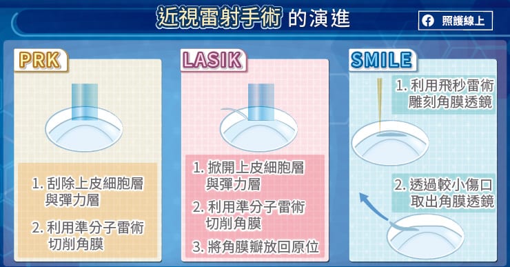 近視雷射手術的演進