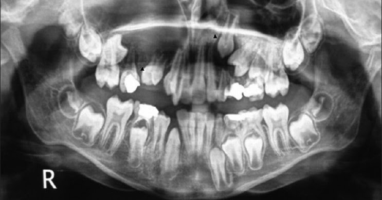 Apakah Gigi yang Dicabut Bisa Tumbuh Lagi?