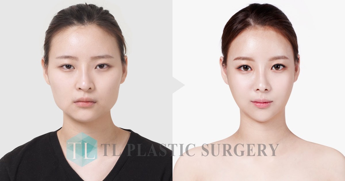 TL PLASTIC SURGERY CLINIC KOREA Before & After