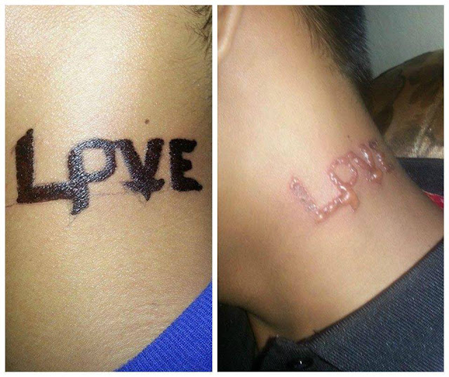 'Black Henna' Tattoo Causes Allergic Reaction to Skin That Leaves a