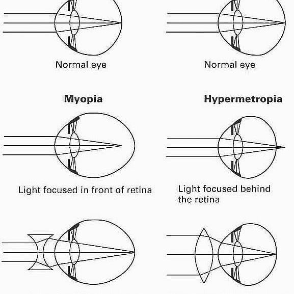 myopia terápia hogyan lehet megtanulni, ha gyenge a látása