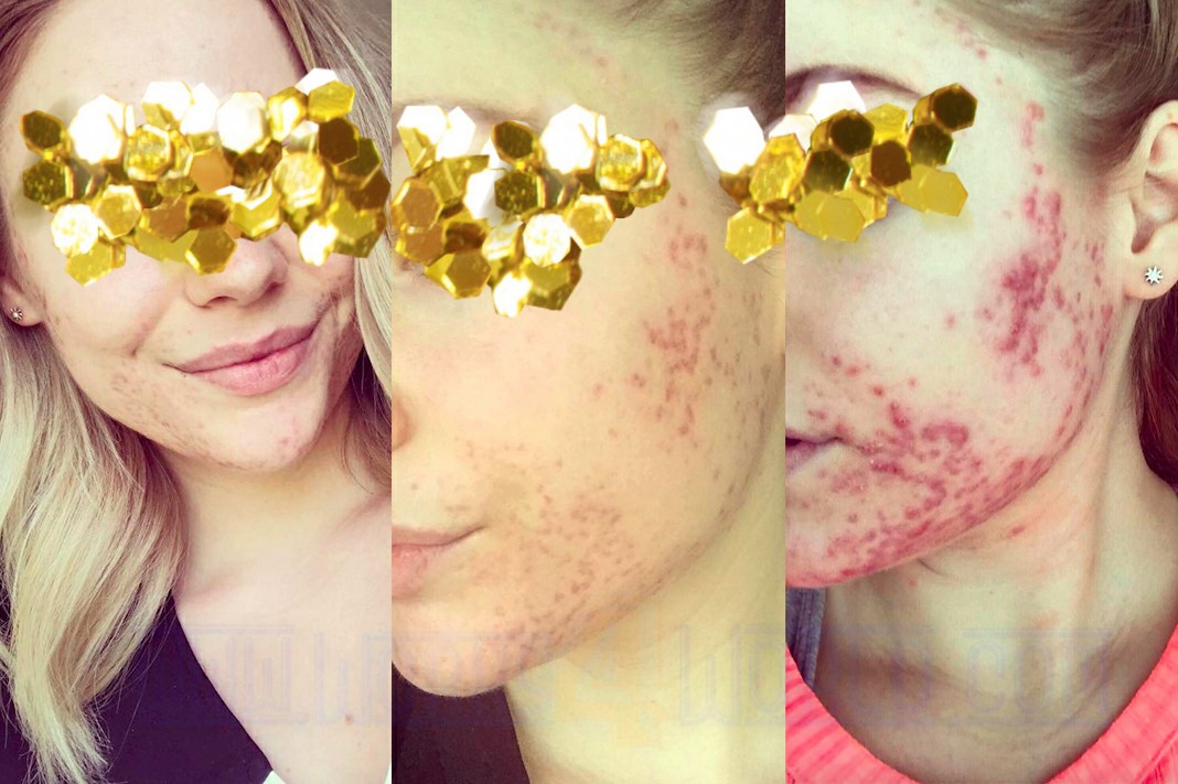 Acne cure works4world