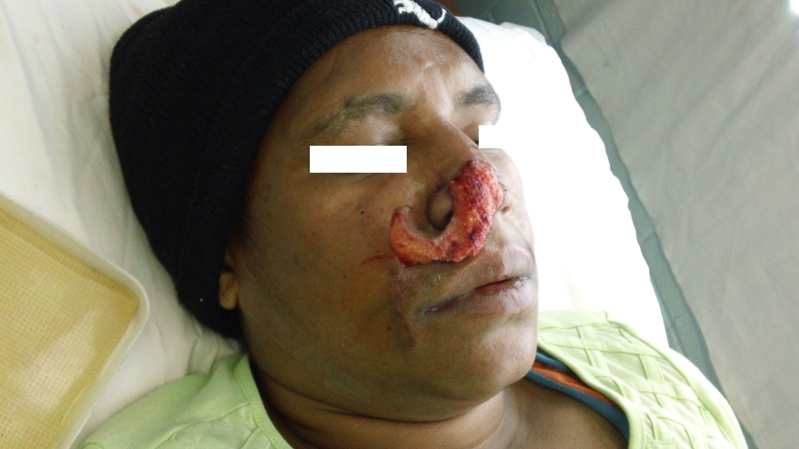 Facial flap surgery — 1
