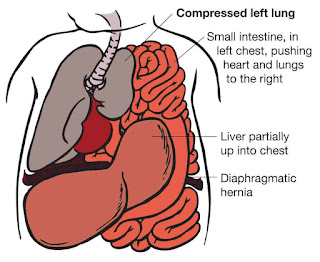 diaphragmatic hernia