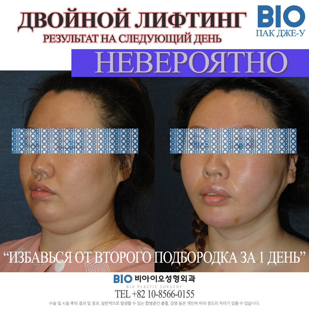 хирургическое уменьшение талии. постакне пластическая операция. биос клиника пластической хирургии иваньковское шоссе отзывы. биос пластическая хирургия. Bios clinic пластическая хирургия.