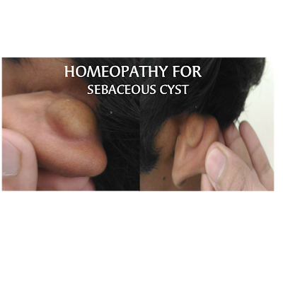 Homeopathy for sebaceous cyst 