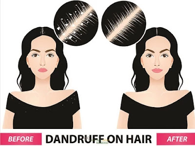 Dandruff natural ways to treat 5 Natural