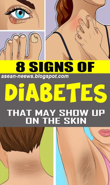 8 Signs Of Diabetes That May Show Up On The Skin