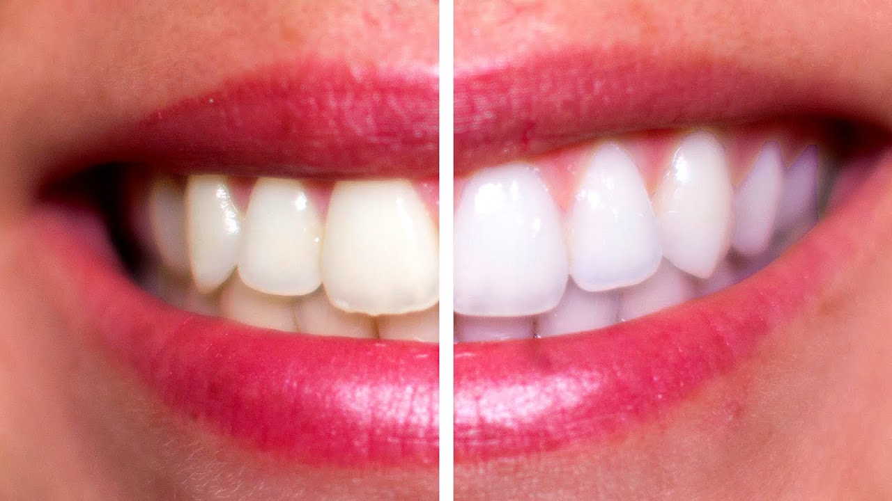 Getting Teeth Professionally Whitened Professional Choices