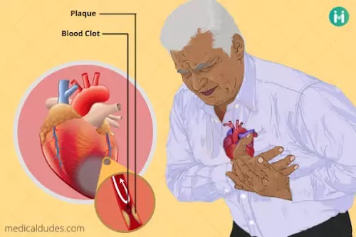 हार्ट अटैक heart attack
