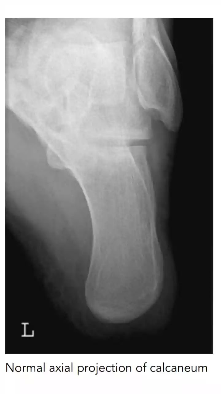 Radiographic Assessment of Pediatric Foot Alignment: Review | AJR