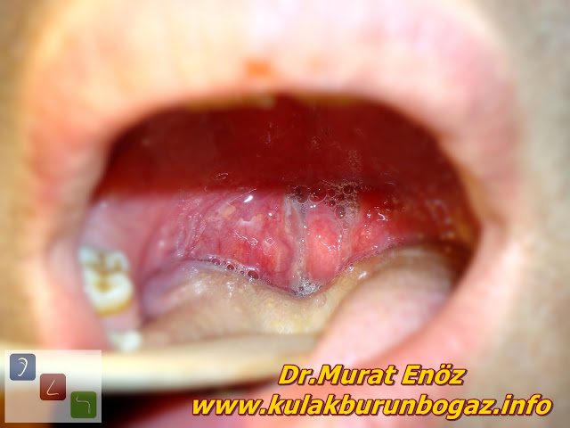 Hypertrophic tonsils - kissing tonsils