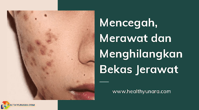 Mencegah, Merawat dan Menghilangkan Bekas Jerawat Mencegah, Merawat dan Menghilangkan Bekas Jerawat