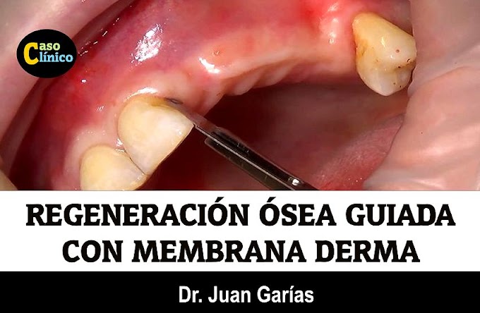 CIRUGÍA PERIODONTAL: Regeneración ósea guiada con membrana Derma - Dr. Juan Garías