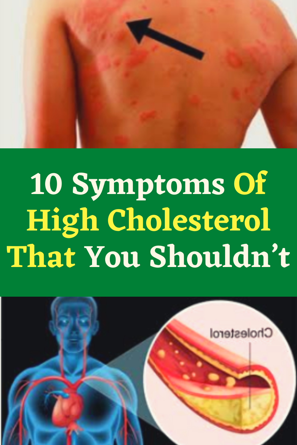10 Symptoms Of High Cholesterol That You Shouldn’t