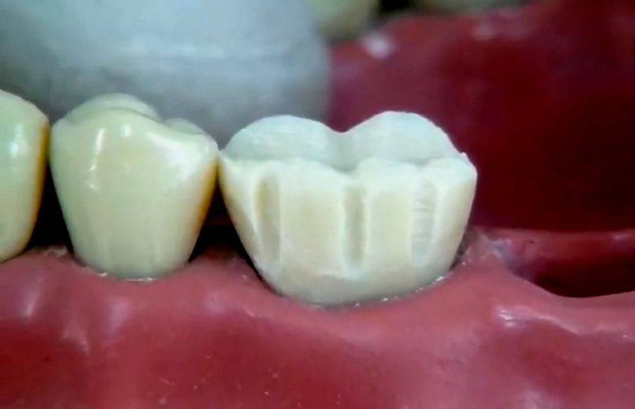 Preparation of a complete molar crown step by step Ovi Dental Go