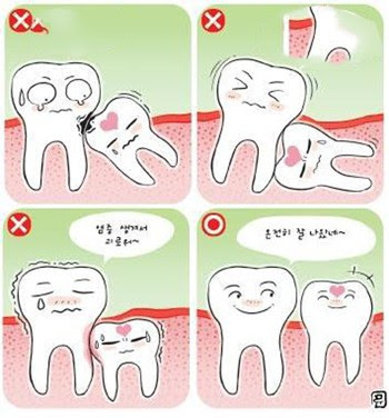 Biểu hiện khi răng khôn hàm trên mọc ngầm? 