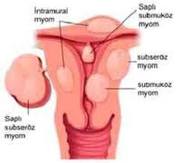 obat-alami-kista-ovarium-indung-telur