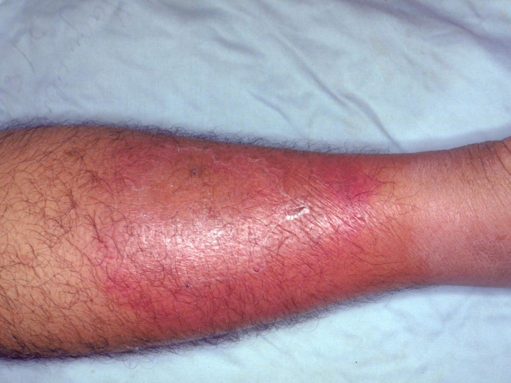 Continuing Professional Development For Management of Cellulitis