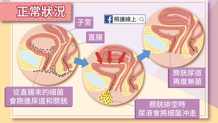 原因 膀胱 女 炎