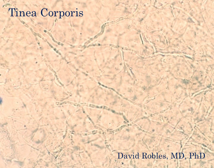 Tinea corporis ("Ringworm")