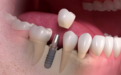 crown on dental implant