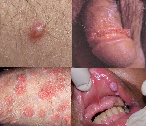 Pictures of Genital and Anal Warts - Wartrin.com