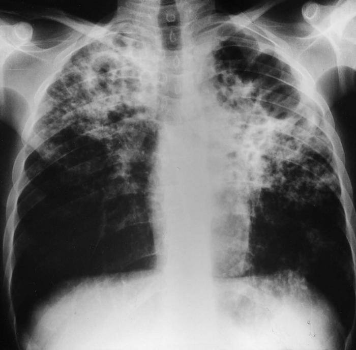 Ru туберкулез. Поражение органов туберкулезом. Снимки туберкулеза легких.