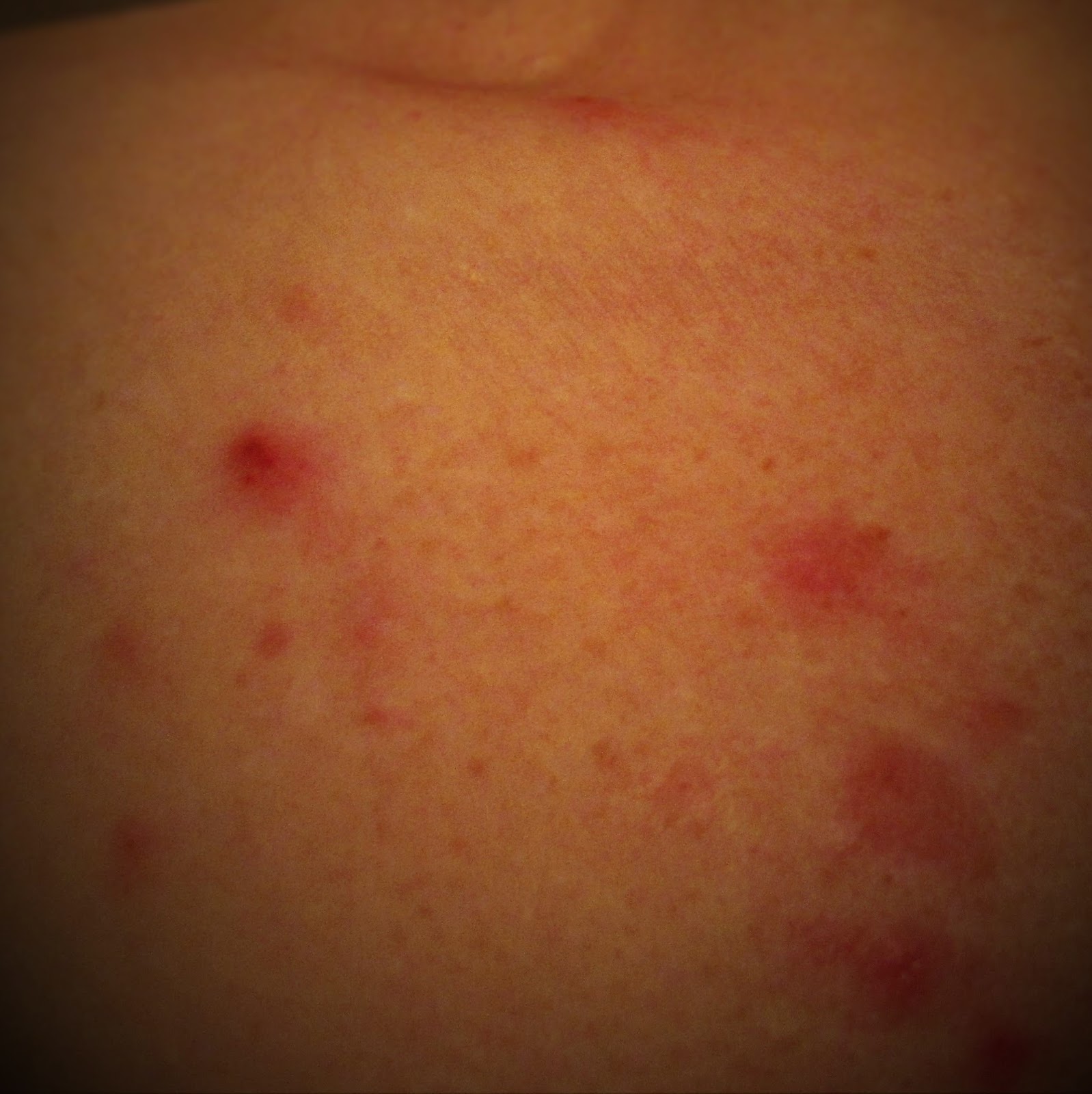 Severe Tegaderm Reaction?  Your Guide To Finding Relief - yd0oqhq