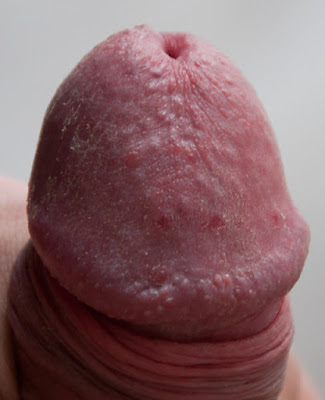 Yeast On Penis 18