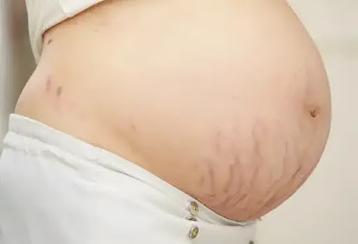 Stretch marks Stretch marks