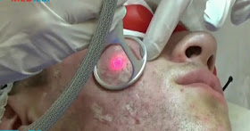 Pelepasan kulit dengan laser