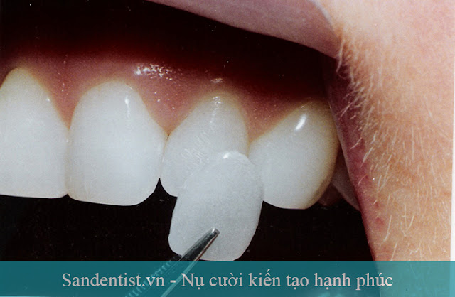 Thẩm mỹ răng bị thưa bằng công nghệ phủ răng sứ
