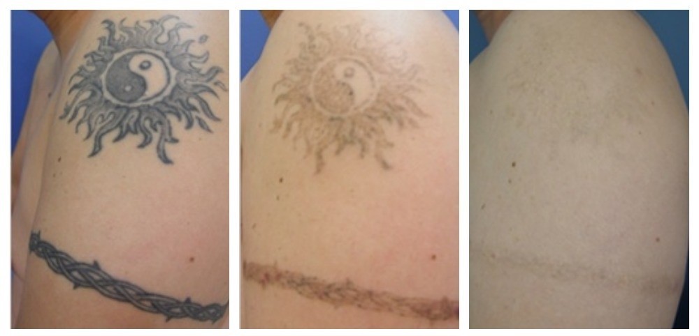 Несколько месяцев после того как. Лазерное удаление тату. Удаление тату до и после. Тату после удаления лазером.