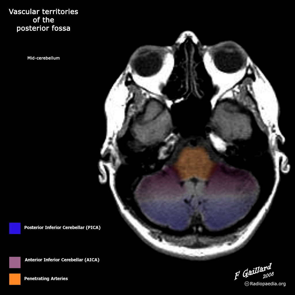 Anatomía de la Fosa Posterior en Tomografía Computada y Resonancia
